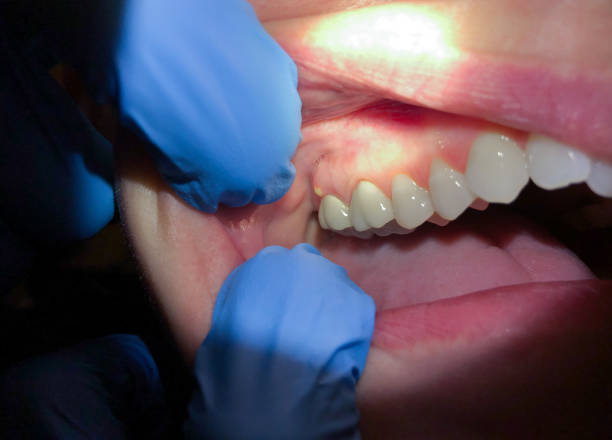 Best Broken or Cracked Tooth Emergency Dentist in Center Point, NM